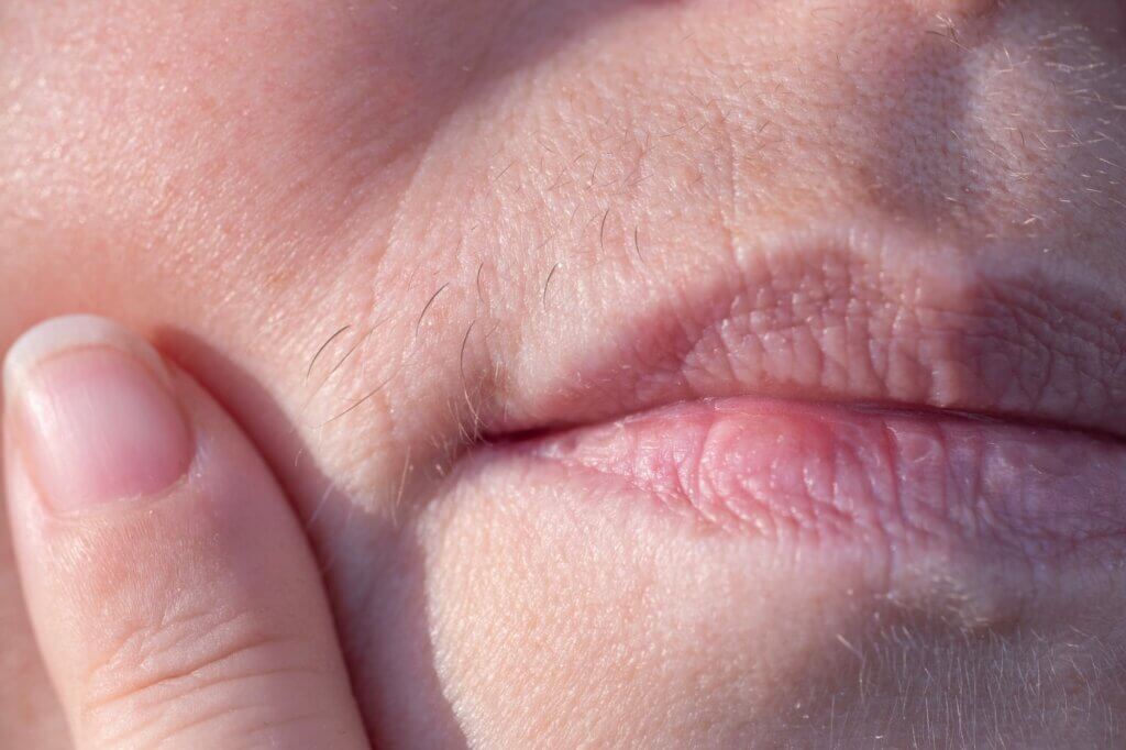 close-up mature female lips, removes excess facial hair, excessive hair growth, Increased androgen levels, accept themselves and appearance